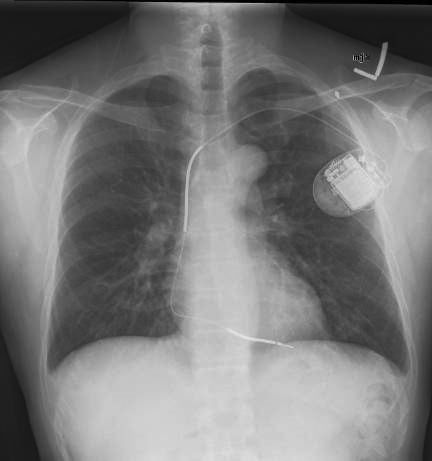 Close to Her Heart: Terri Hoehn’s life depends on an implantable cardiac defibrillator – Panama ...